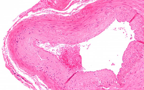 5A2 Vasculitis, temporal artery, healed (Case 5) 20X