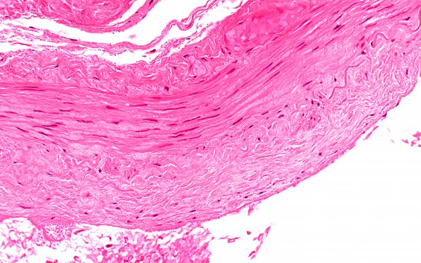 5A3 Vasculitis, temporal artery, healed (Case 5) 40X