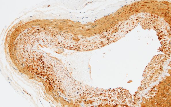 5B2 Vasculitis, temporal artery, healed (Case 5) SMA 20X