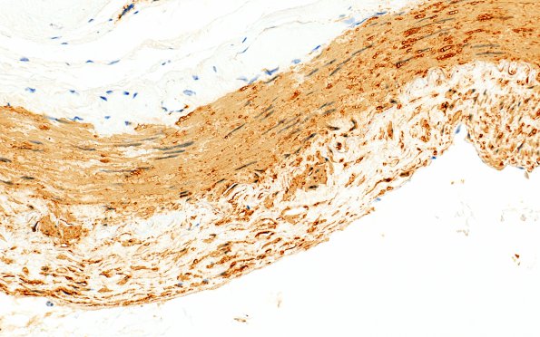 5B3 Vasculitis, temporal artery, healed (Case 5) SMA 40X