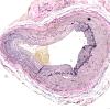 5C1 Vasculitis, temporal artery, healed (Case 5) VVG 10X