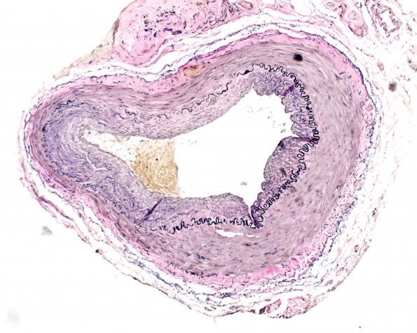 5C1 Vasculitis, temporal artery, healed (Case 5) VVG 10X