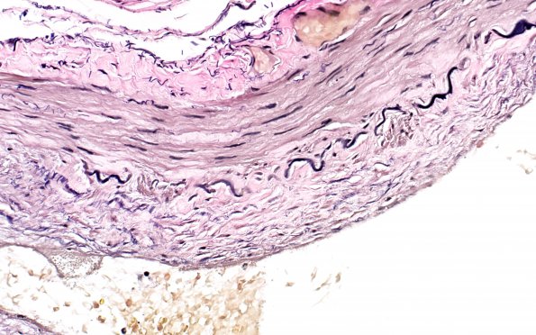 5C3 Vasculitis, temporal artery, healed (Case 5) VVG 40X