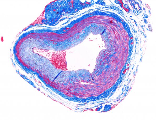 5D1 Vasculitis, temporal artery, healed (Case 5) Trichrome 10X