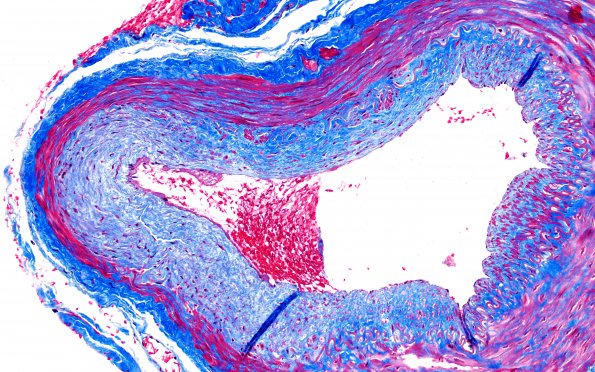 5D2 Vasculitis, temporal artery, healed (Case 5) Trichrome 20X