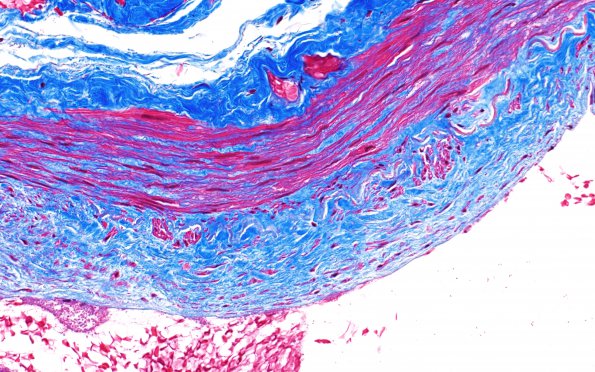 5D3 Vasculitis, temporal artery, healed (Case 5) Trichrome 40X