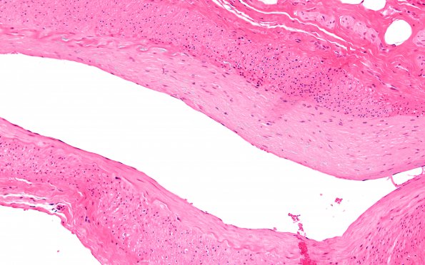 5E1 Vasculitis, temporal artery, healed (Case 5) Area A H&E 20X