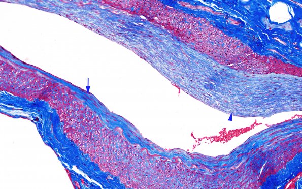 5E10 Vasculitis, temporal artery, healed (Case 5) Area A TRI 20X copy