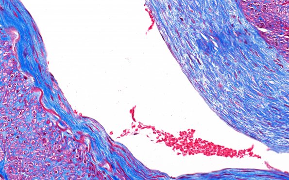 5E11 Vasculitis, temporal artery, healed (Case 5) Area A TRI 40X