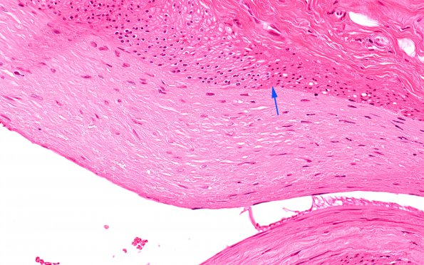 5E2 Vasculitis, temporal artery, healed (Case 5) Area A H&E 40X copy