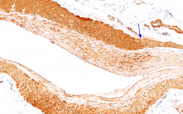 5E4 Vasculitis, temporal artery, healed (Case 5) Area A SMA 20X copy