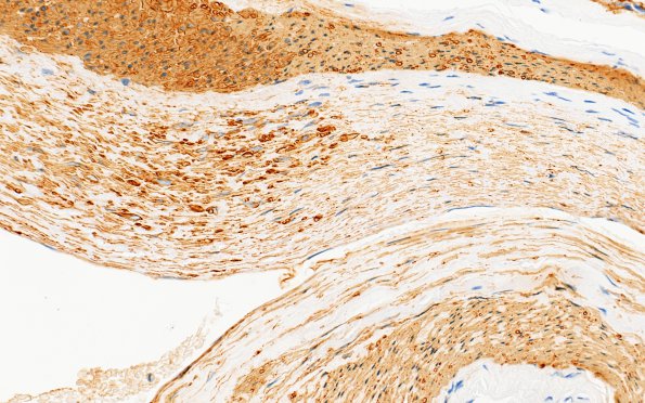 5E5 Vasculitis, temporal artery, healed (Case 5) Area A SMA 40X