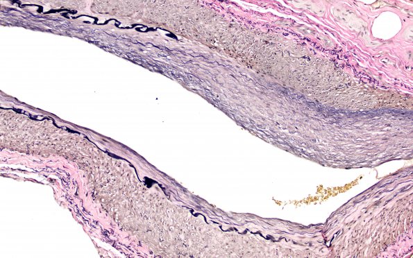 5E7 Vasculitis, temporal artery, healed (Case 5) Area A VVG 20X