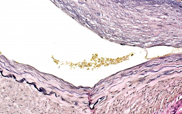 5E8 Vasculitis, temporal artery, healed (Case 5) Area A VVG 40X 2