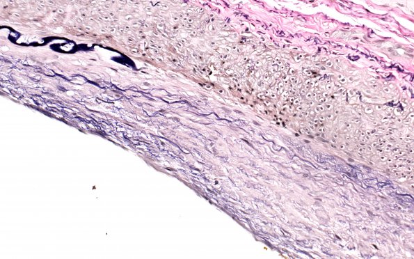 5E9 Vasculitis, temporal artery, healed (Case 5) Area A VVG 40X