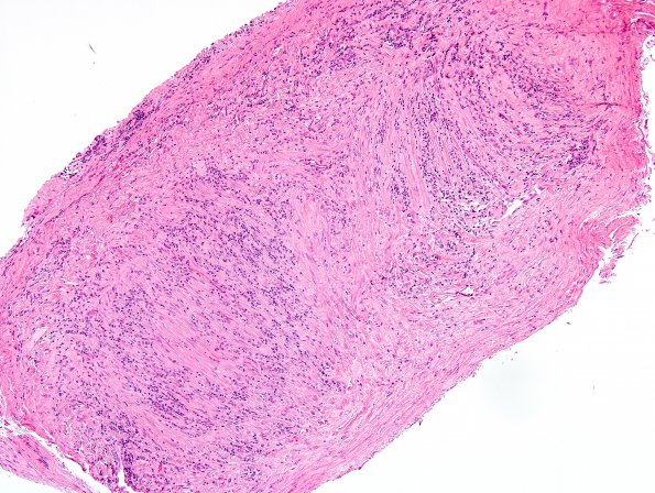 6A1 Arteritis, giant cell (Case 6) H&E 7