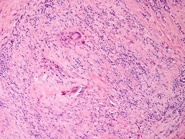 6A2 Arteritis, giant cell (Case 6) H&E 2