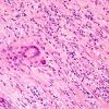 6A3 Arteritis, giant cell (Case 6) H&E 3