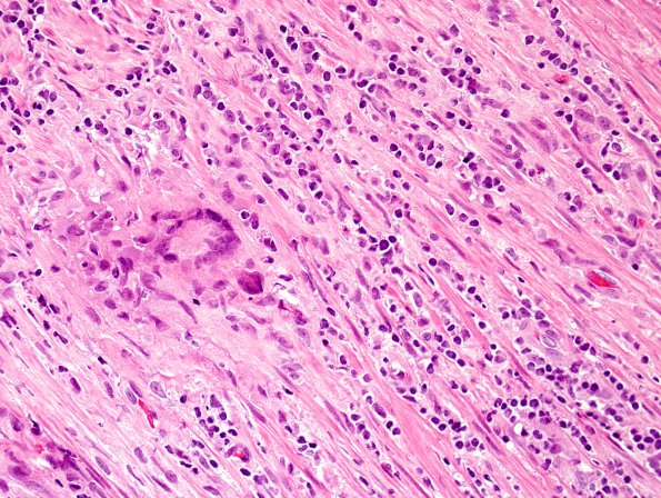 6A3 Arteritis, giant cell (Case 6) H&E 3