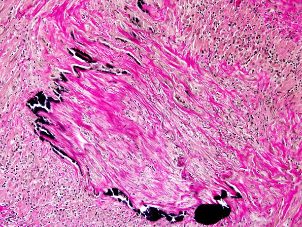 6B2 Arteritis, giant cell (Case 6) Elastin 2