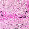 6B3 Arteritis, giant cell (Case 6) Elastin 1