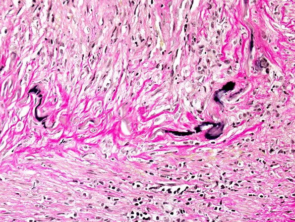 6B3 Arteritis, giant cell (Case 6) Elastin 1