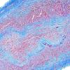 6C1 Arteritis, giant cell (Case 6) Trichrome 3.