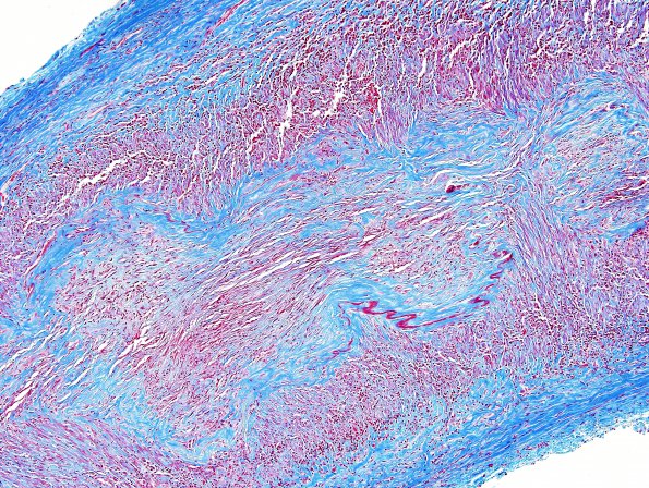 6C1 Arteritis, giant cell (Case 6) Trichrome 3.