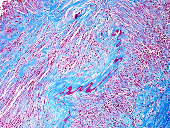 6C2 Arteritis, giant cell (Case 6) Trichrome 1