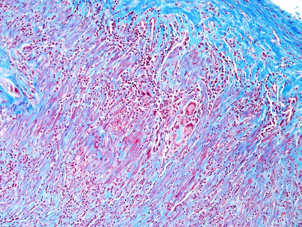 6C3 Arteritis, giant cell (Case 6) Trichrome 2