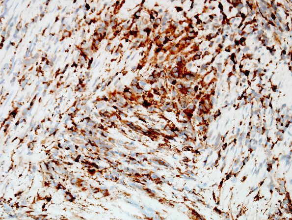 6D3 Arteritis, giant cell (Case 6) CD68 2