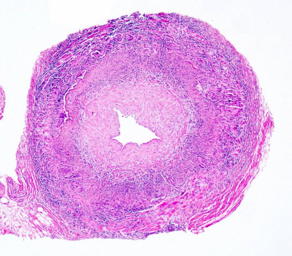 7A1 Temporal Arteritis (Case 7) 2