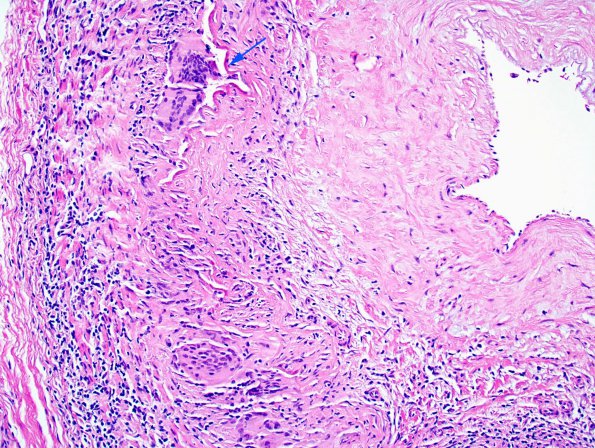 7A2 Temporal Arteritis (Case 7) 4 copy