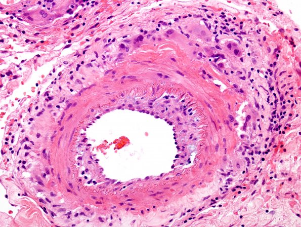 10A1 Vasculitis, primary CNS (Case 10) H&E 2