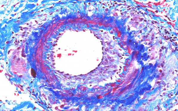 10B1 Vasculitis, primary CNS (Case 10) Trichrome 40X