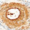 10C1 Vasculitis, primary CNS (Case 10) SMA 40X