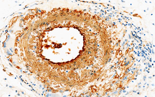 10C1 Vasculitis, primary CNS (Case 10) SMA 40X