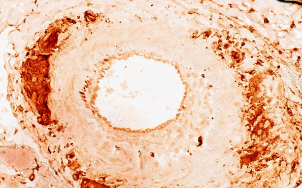 10D Vasculitis, primary CNS (Case 10) CD68 40X