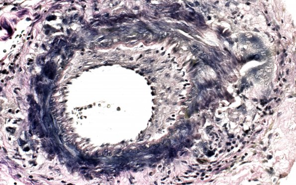 10E Vasculitis, primary CNS (Case 10) VVG 40X