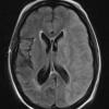 11A1 Infarct, 1-2 days, PMNs, DDx vasculitis (Case 11) TRA FLAIR - Copy