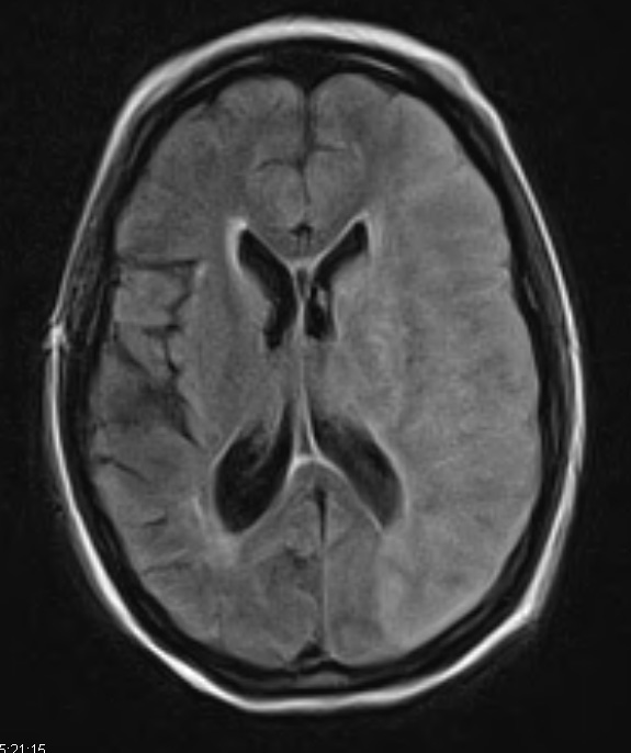 11A1 Infarct, 1-2 days, PMNs, DDx vasculitis (Case 11) TRA FLAIR - Copy