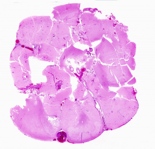 11B1 Infarct, 1-2 days, PMNs, DDx vasculitis (Case 11) H&E WM