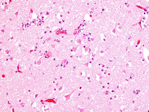 11B3 Infarct, 1-2 days, PMNs, DDx vasculitis (Case 11) H&E 4