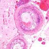 11B5 Infarct, 1-2 days, PMNs, DDx vasculitis (Case 11) H&E 13