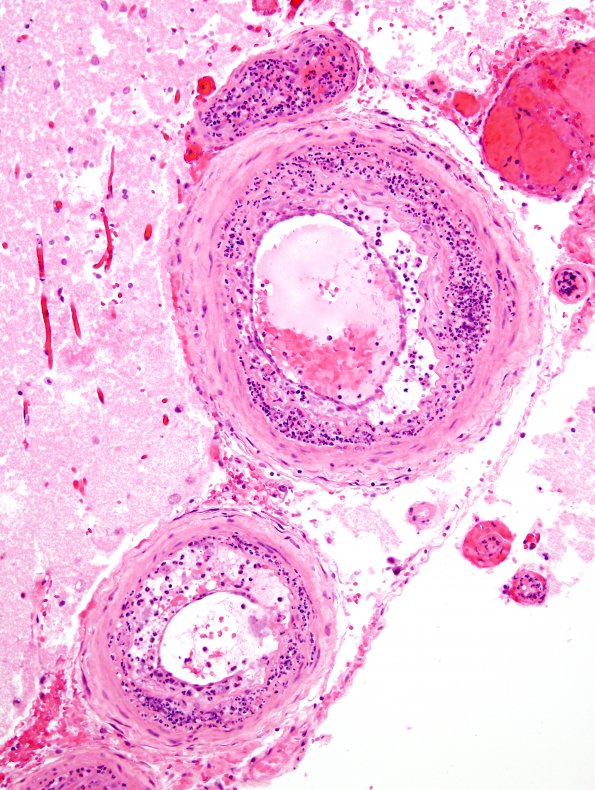 11B5 Infarct, 1-2 days, PMNs, DDx vasculitis (Case 11) H&E 13