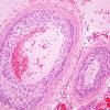 11B7 Infarct, 1-2 days, PMNs, DDx vasculitis (Case 11) H&E 15