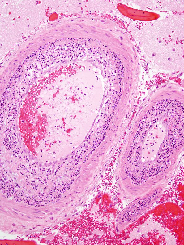 11B7 Infarct, 1-2 days, PMNs, DDx vasculitis (Case 11) H&E 15