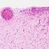 11B8 Infarct, 1-2 days, PMNs, DDx vasculitis (Case 11) H&E 24