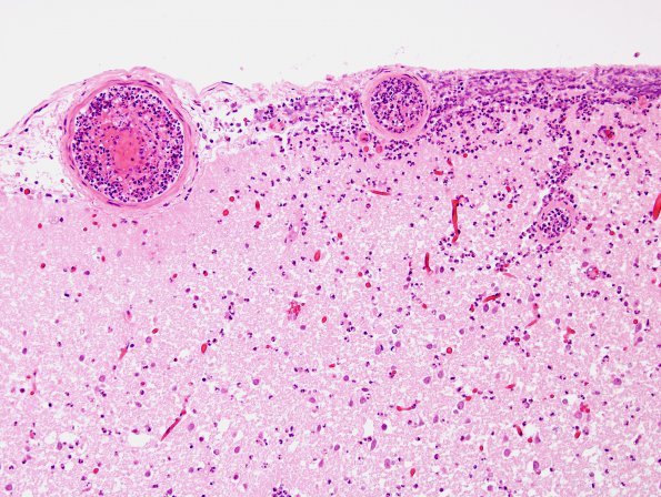 11B8 Infarct, 1-2 days, PMNs, DDx vasculitis (Case 11) H&E 24