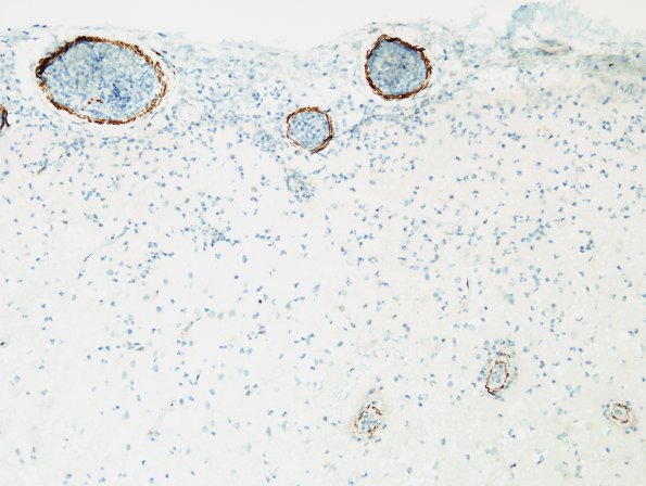 11B9 Infarct, 1-2 days, PMNs, DDx vasculitis (Case 11) SMA 2